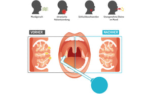 Mandelsauger Tonsillensteinentferner | Entfernung von Mandelsteinen | Gegen Mundgeruch | Glas | Lindert Halsschmerzen | Mandelsteine entfernen